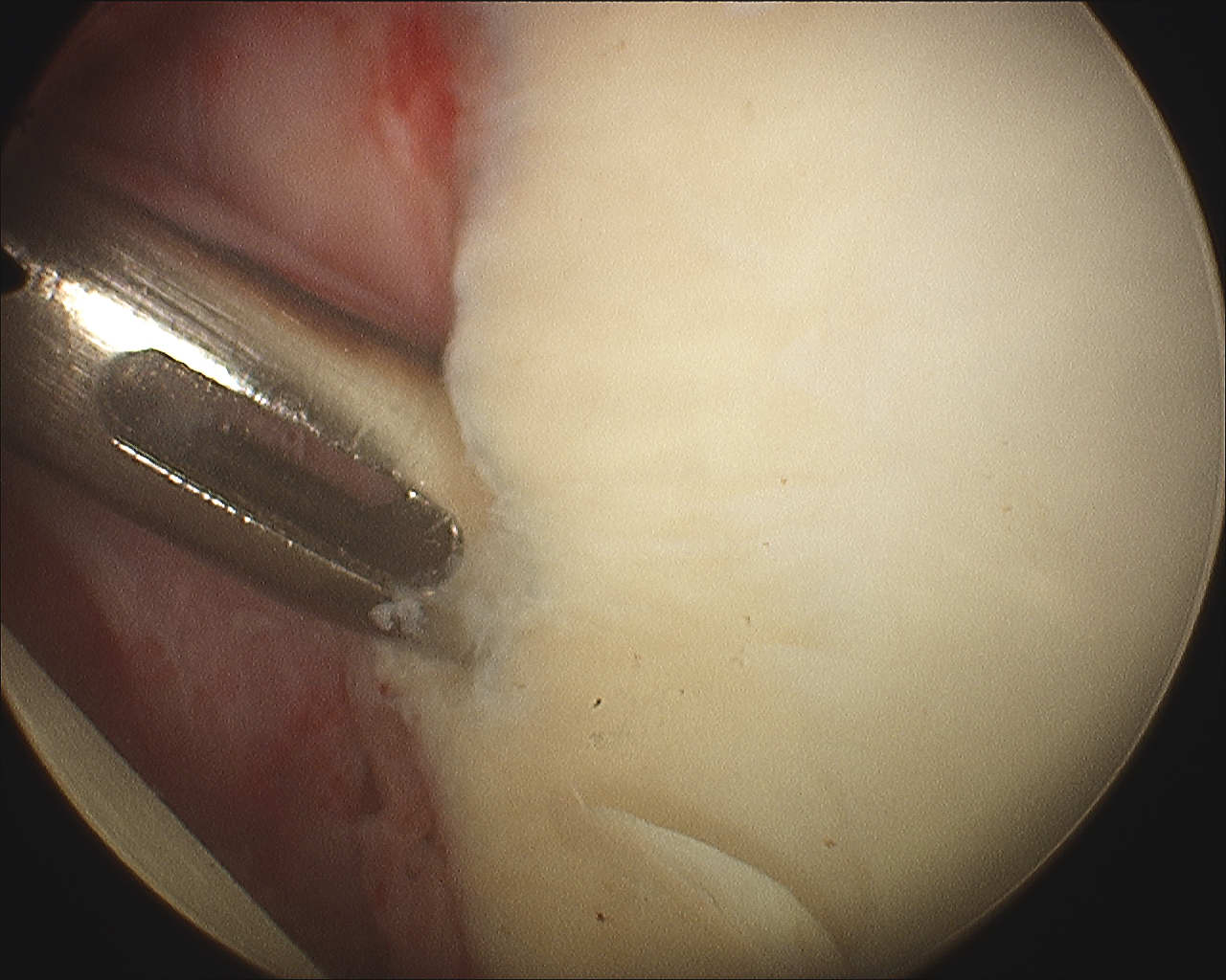 Arthroscopy Bankart Anchor Drill Guide